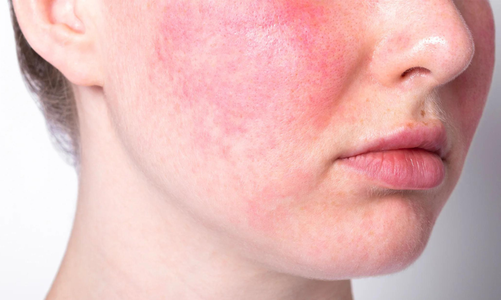 How to Choose Makeup for Rosacea