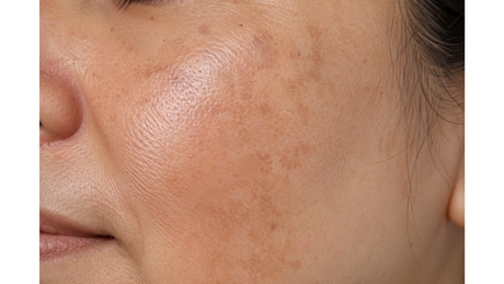 Why Your Skin Gets More Uneven After 40